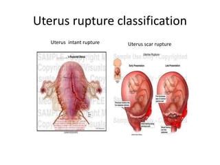 Uterus rupture and uterus cervix rupture | PPT