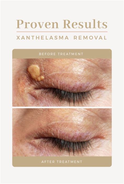 Xanthelasma Removal