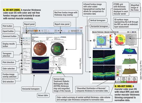 The Anatomy of an OCT Scan