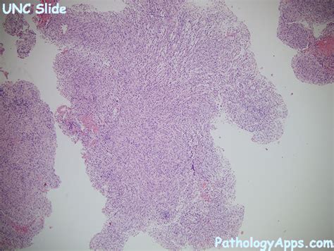 pilocytic astrocytoma pathology