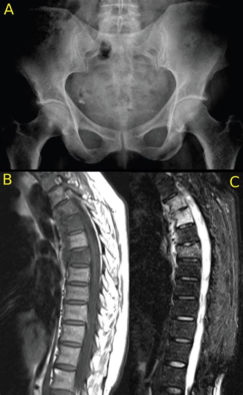 Imaging of Axial Psoriatic Arthritis - The Rheumatologist