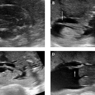 Ultrasound images of amniotic band syndrome and a lumbosacral... | Download Scientific Diagram