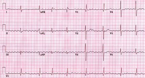 Does atrial flutter always turn into afib flutter - juluside