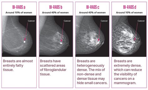 BreastScreen SA • Breast density