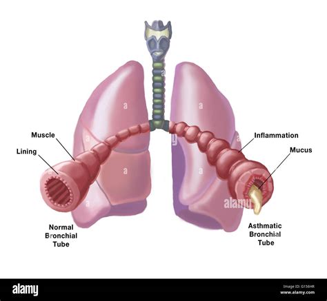 Illustration of the bronchial tubes of the lungs, comparing the appearance of a normal, healthy ...