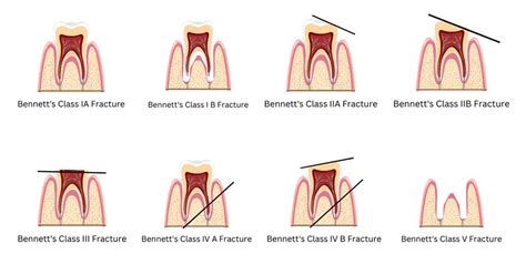 Tooth fracture classification - Focus Dentistry