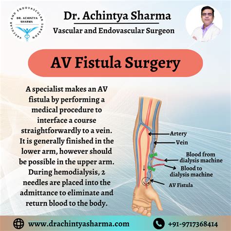 AV Fistula Surgery