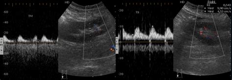 Transplant renal artery stenosis – percutaneous transluminal angioplasty and stenting | Eurorad