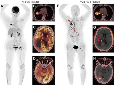 Comparison of 68Ga-FAPI and 18F-FDG PET/CT in the Evaluation of Advanced Lung Cancer | Radiology