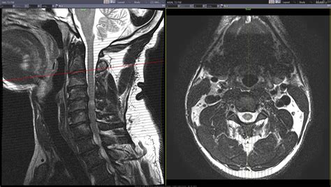 Can A Pedestrian Car Accident Cause Myelomalacia?