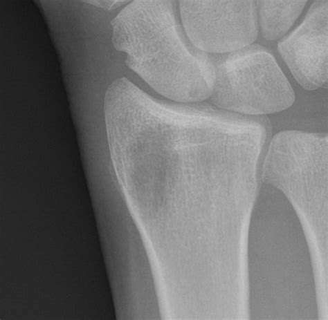 Benign lucent bone lesions | Radiology Case Collection | Radshare.net