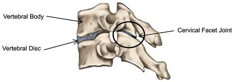 IJERPH | Free Full-Text | Medial Branch Blocks for Diagnosis of Facet ...