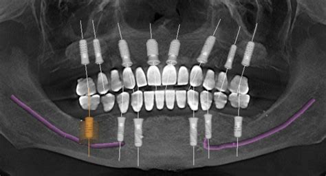 How Many Implants in the Edentulous Maxilla? - Spear Education