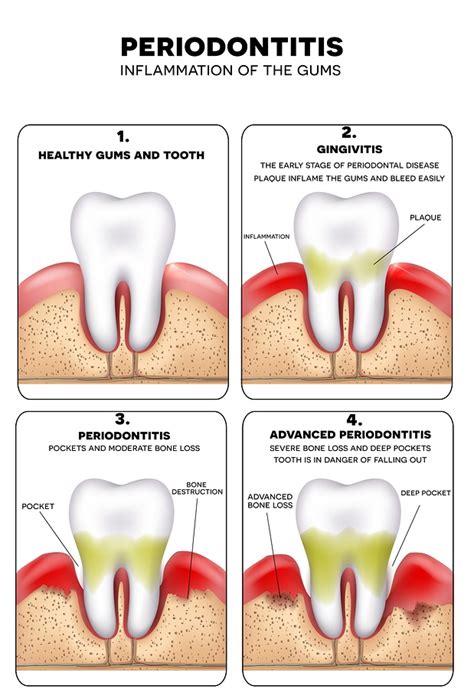 About gum disease causes care and treatment | Dr Medina 702-368-3627