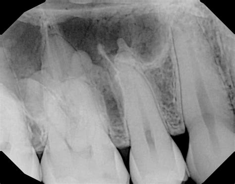 Periapical and Bitewing Radiopacities - Radiodontics