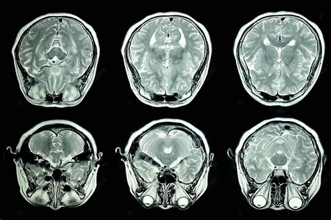 Nền Chụp Mri Não X Bức Xạ Máy Tính Hình Chụp Và Hình ảnh Để Tải Về Miễn Phí - Pngtree