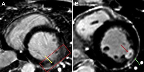 Ablation of Incessant Premature Ventricular Complex Through Retrograde Transvenous Ethanol ...