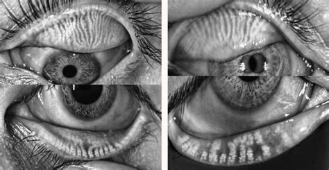 Lesson: How to Conduct a Good Dry Eye Assessment