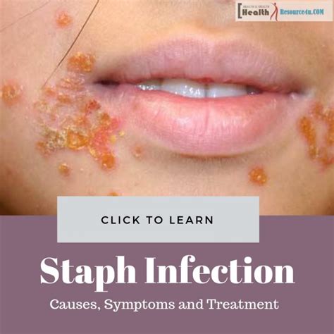 Staph Infection : Causes, Picture, Symptoms And Treatment