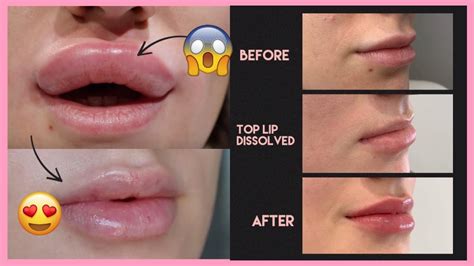 Why Are My Lips Swollen After Fillers | Lipstutorial.org