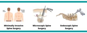 Minimally Invasive Spine Surgery in Mumbai | Dr Bhavin Shial