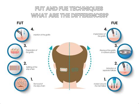 Which hair transplant method is best for you? | Bio Hair Clinic