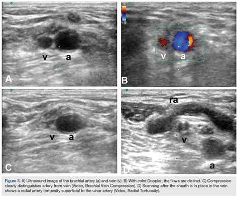 Ultrasound Guidance for Upper Extremity Arterial and Venous Access