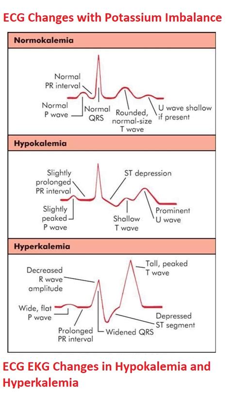 Hypokalemia Hyperkalemia Ecg