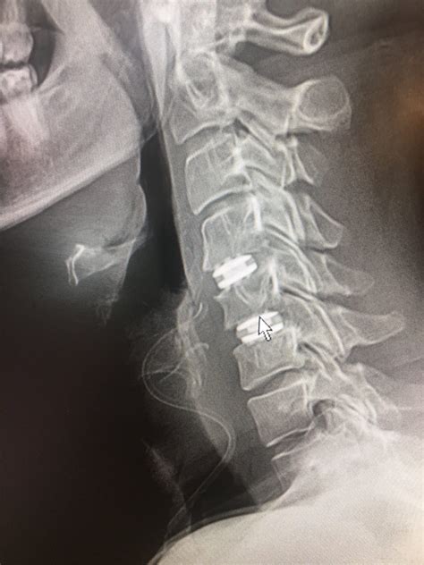 Cervical Artificial Disc Replacement (ADR) Vs. Anterior Cervical Discectomy And Fusion (ACDF ...