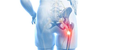 Optimizing Treatment for Patients With Chronic Sciatica: Gabapentin vs ...