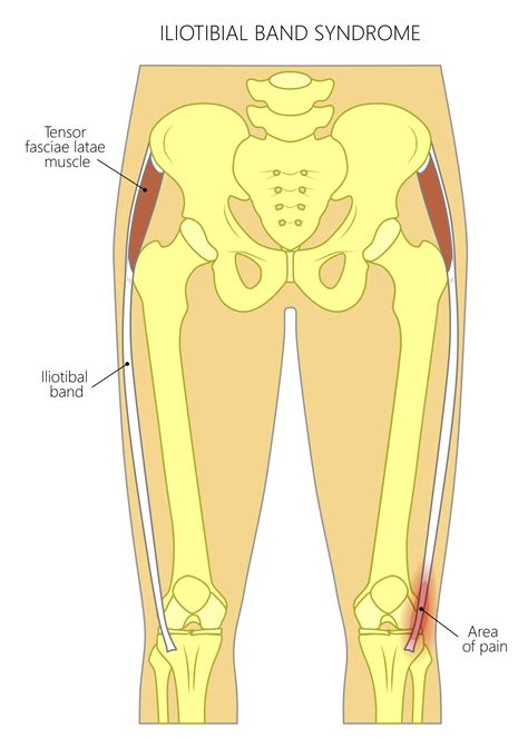 IT Band Syndrome - Austin Chen MD