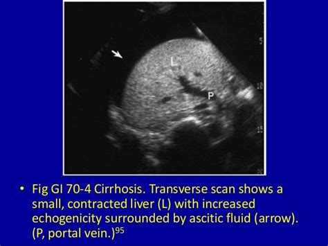 70 generalized increased echogenicity of the liver