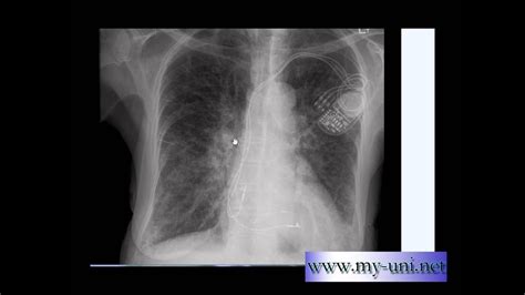 Kerley B Lines Pulmonary Edema