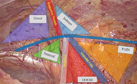 Anatomy Of Laparoscopic Inguinal Hernia Triangle