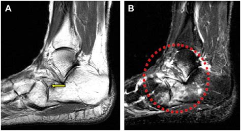 Ankle Sprain Treatment | OrthofootMD