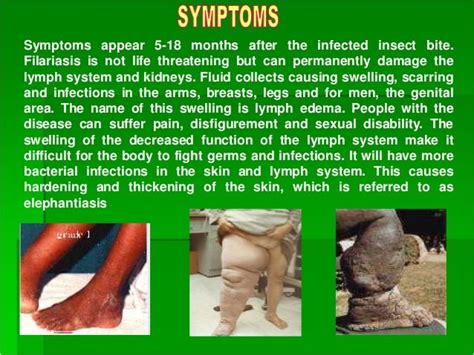 Elephantiasis presentation1