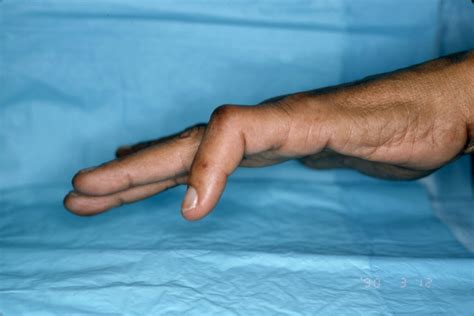 BOUTONNIERE DEFORMITY | Hand Surgery Resource