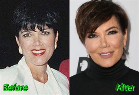 Kris Jenner Plastic Surgery: A Really Beautiful Granny