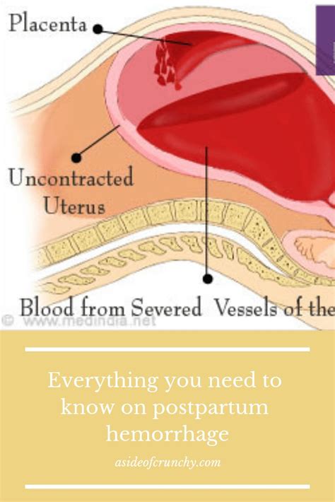 Everything you need to know on postpartum hemorrhage | Postpartum hemorrhage, Postpartum, Hemorrhage