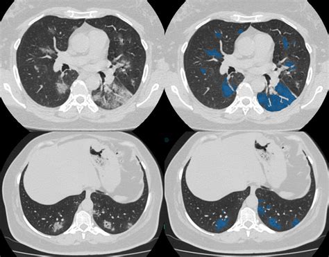 CT scan database of 1000 sets was created for teaching AI to diagnose COVID-19