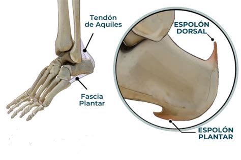 Espolón calcáneo del pie: causas, síntomas y tratamientos | Traumatología