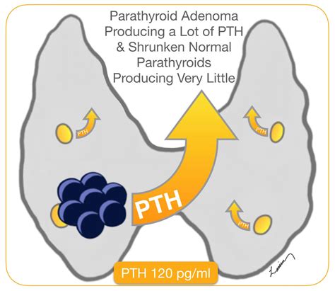 parathyroid adenoma producing a lot of PTH & shrunken normal parathyroids producing very llittle ...