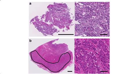 Photomicrographs of a case harboring a PIK3CA mutation in both types of... | Download Scientific ...