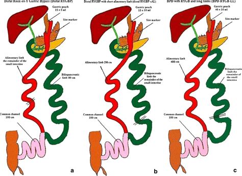 Schematic representation of the studied procedures. a Distal Roux-en-Y ...