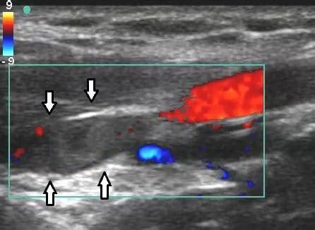 Blood Clot In Leg Ultrasound