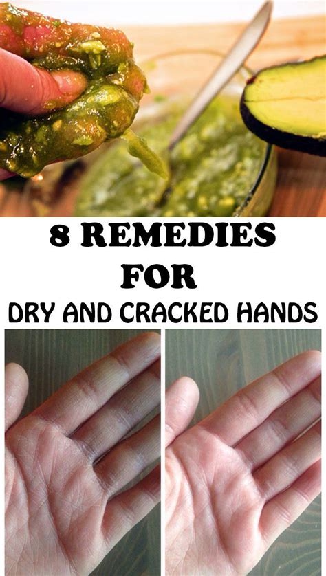 8 Remedies for Dry and Cracked Hands | Cracked hands, Dry hands remedy, Dry hands treatment