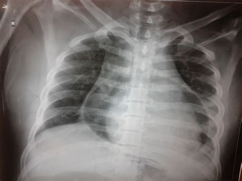 Non-traumatic Pneumopericardium-CXR - Sumer's Radiology Blog