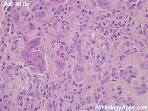 giant cell tumor of tendon sheath soft tissue histology