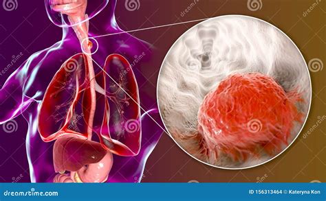 Esophageal Cancer, Illustration And Micrograph | CartoonDealer.com ...