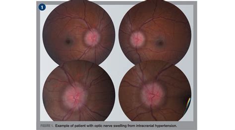 Used to Describe Edema of the Optic Nerve